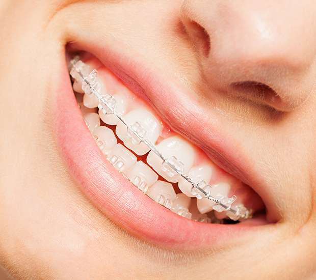 Laurel Springs Clear Braces