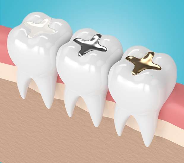 Laurel Springs Composite Fillings