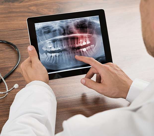 Laurel Springs Types of Dental Root Fractures